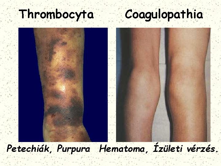 Thrombocyta Coagulopathia Petechiák, Purpura Hematoma, Ízületi vérzés. 