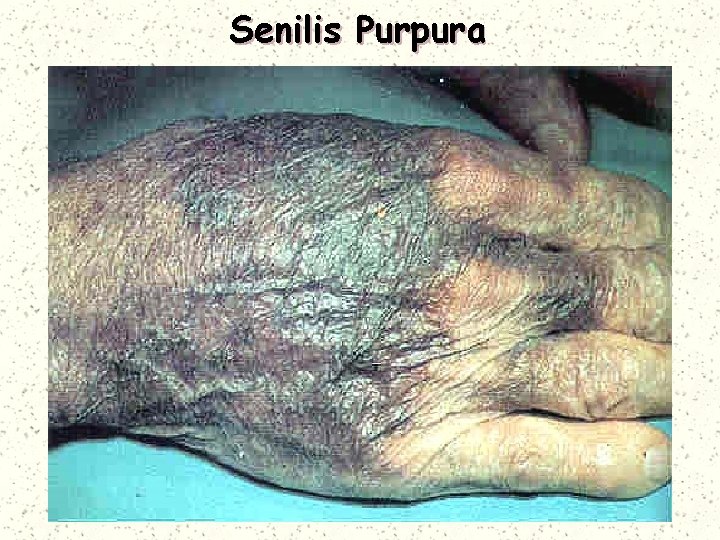 Senilis Purpura 