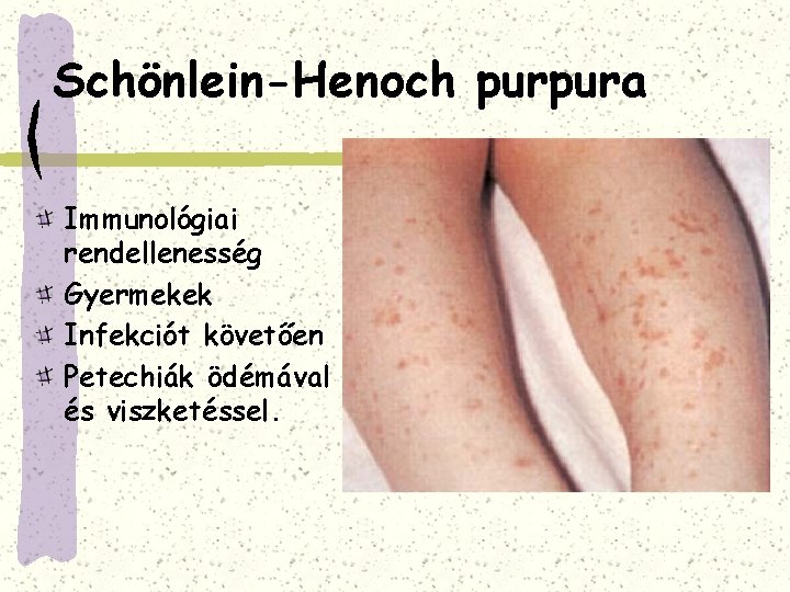 Schönlein-Henoch purpura Immunológiai rendellenesség Gyermekek Infekciót követően Petechiák ödémával és viszketéssel. 