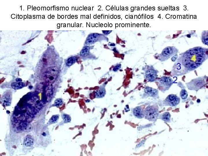 1. Pleomorfismo nuclear 2. Células grandes sueltas 3. Citoplasma de bordes mal definidos, cianófilos
