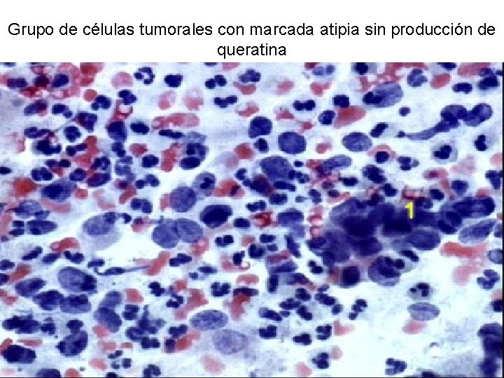 Grupo de células tumorales con marcada atipia sin producción de queratina 
