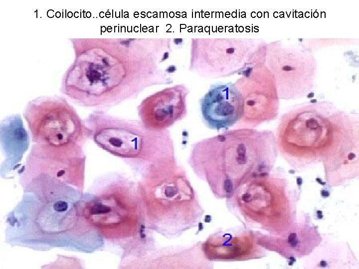 1. Coilocito. . célula escamosa intermedia con cavitación perinuclear 2. Paraqueratosis 