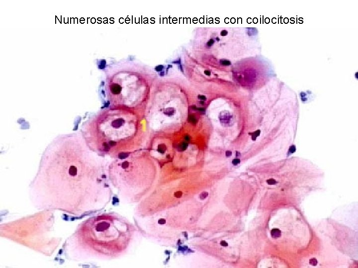 Numerosas células intermedias con coilocitosis 