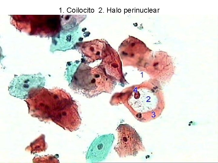 1. Coilocito 2. Halo perinuclear 