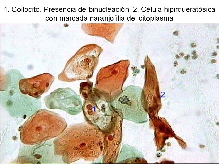 1. Coilocito. Presencia de binucleación 2. Célula hipirqueratósica con marcada naranjofilia del citoplasma 