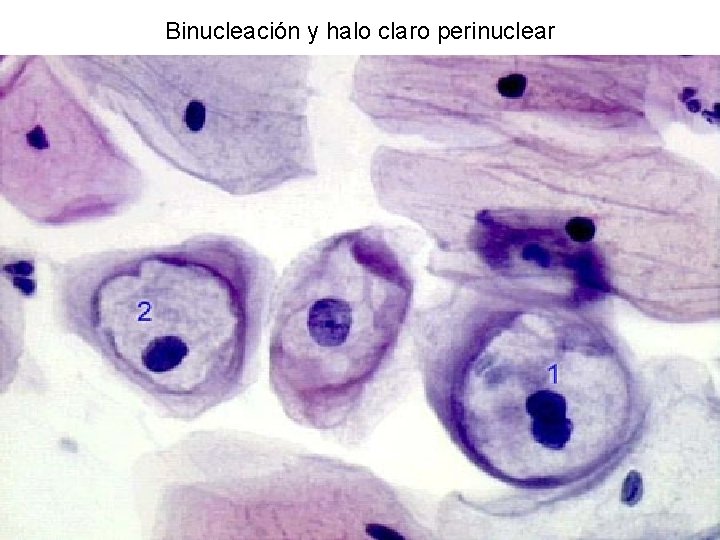 Binucleación y halo claro perinuclear 