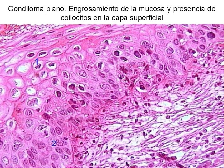 Condiloma plano. Engrosamiento de la mucosa y presencia de coilocitos en la capa superficial