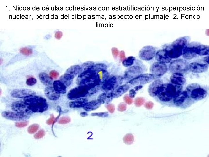 1. Nidos de células cohesivas con estratificación y superposición nuclear, pérdida del citoplasma, aspecto