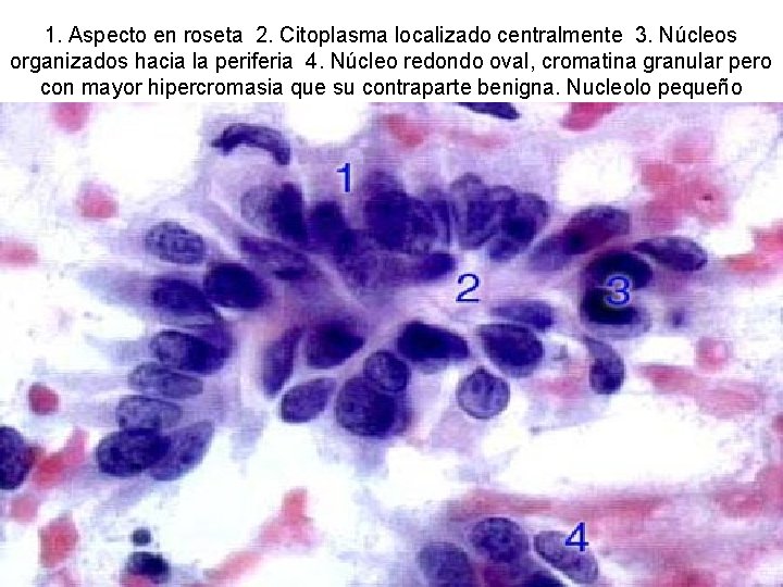 1. Aspecto en roseta 2. Citoplasma localizado centralmente 3. Núcleos organizados hacia la periferia