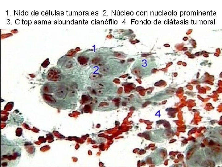 1. Nido de células tumorales 2. Núcleo con nucleolo prominente 3. Citoplasma abundante cianófilo