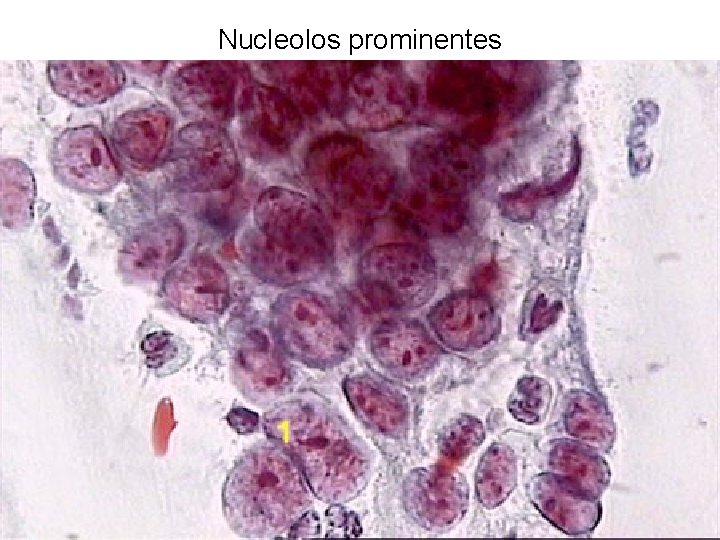 Nucleolos prominentes 