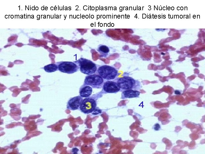 1. Nido de células 2. Citoplasma granular 3 Núcleo con cromatina granular y nucleolo