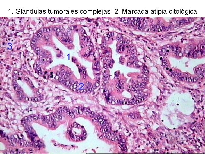 1. Glándulas tumorales complejas 2. Marcada atipia citológica 