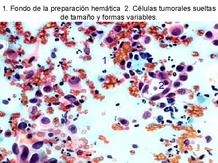 1. Fondo de la preparación hemática 2. Células tumorales sueltas de tamaño y formas