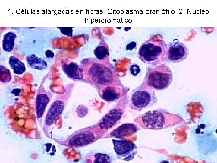1. Células alargadas en fibras. Citoplasma oranjófilo 2. Núcleo hipercromático 