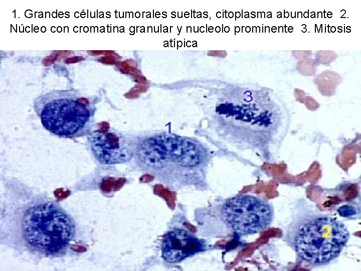 1. Grandes células tumorales sueltas, citoplasma abundante 2. Núcleo con cromatina granular y nucleolo