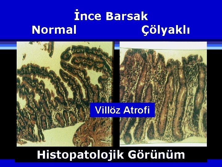 İnce Barsak Normal Çölyaklı Villöz Atrofi Histopatolojik Görünüm 