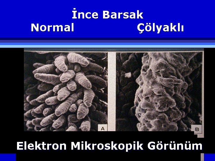 İnce Barsak Normal Çölyaklı Elektron Mikroskopik Görünüm 