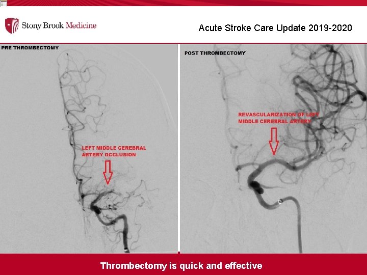 Acute Stroke Care Update 2019 -2020 Thrombectomy is quick and effective 