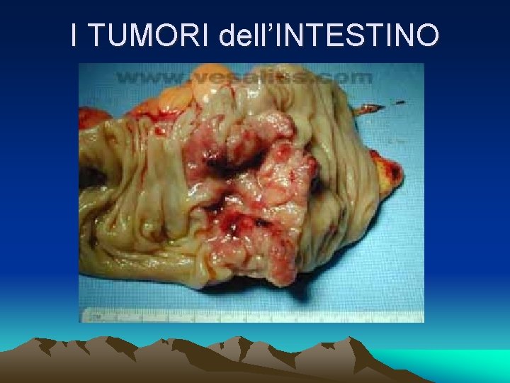 I TUMORI dell’INTESTINO 