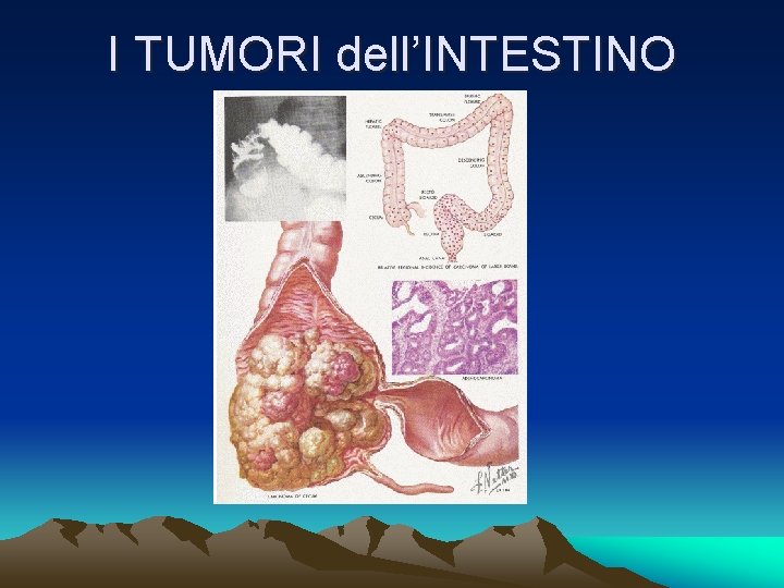 I TUMORI dell’INTESTINO 