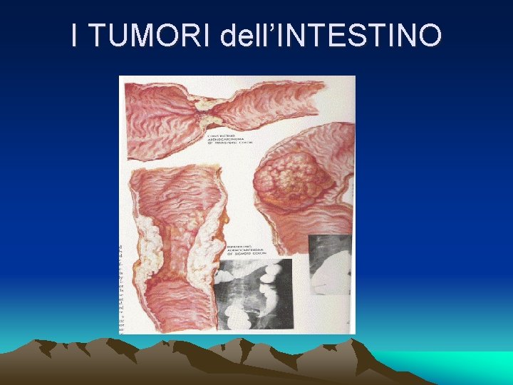 I TUMORI dell’INTESTINO 