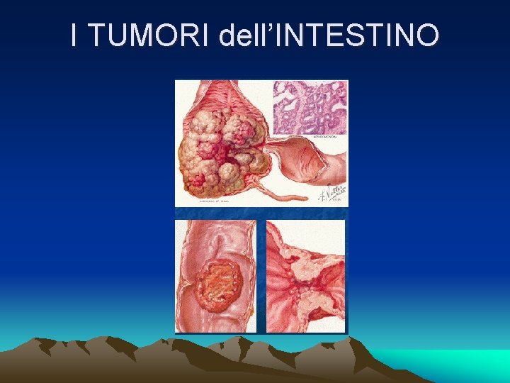 I TUMORI dell’INTESTINO 