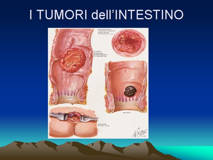 I TUMORI dell’INTESTINO 