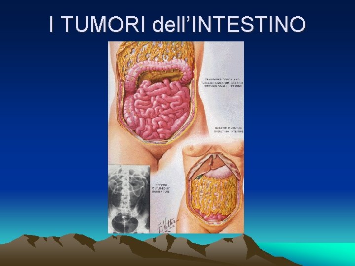 I TUMORI dell’INTESTINO 