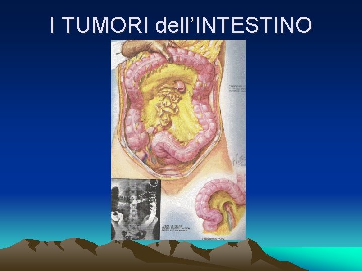 I TUMORI dell’INTESTINO 