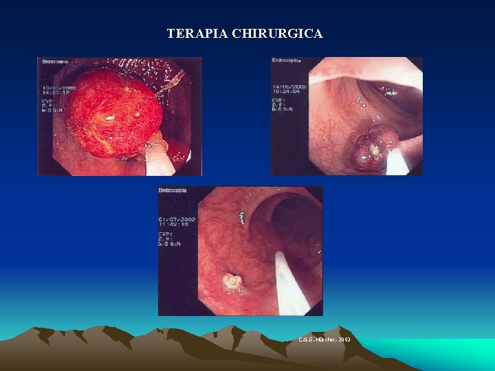 TERAPIA CHIRURGICA C. G. S. Hü Hüscher, 2003 