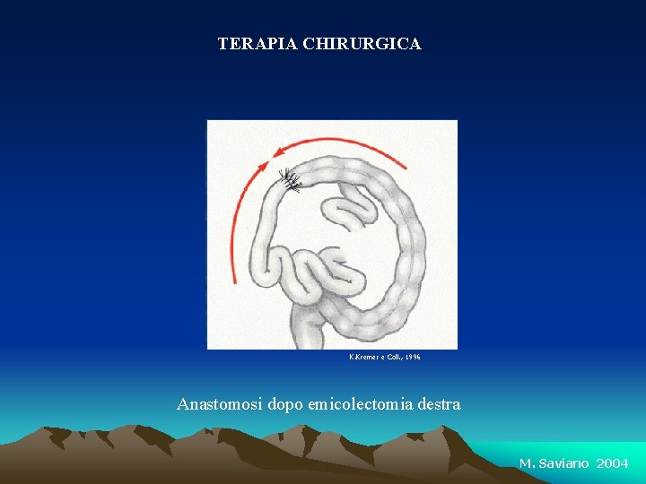 TERAPIA CHIRURGICA K. Kremer e Coll. , 1996 Anastomosi dopo emicolectomia destra M. Saviano