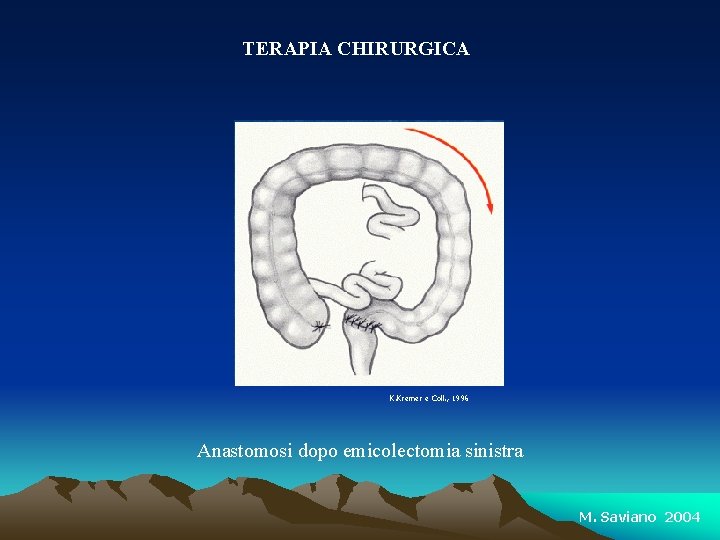 TERAPIA CHIRURGICA K. Kremer e Coll. , 1996 Anastomosi dopo emicolectomia sinistra M. Saviano