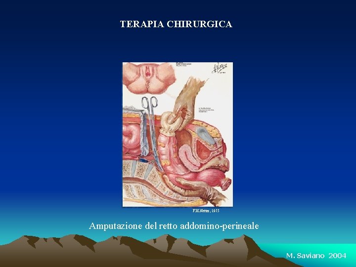 TERAPIA CHIRURGICA F. H. Netter, 1975 Amputazione del retto addomino-perineale M. Saviano 2004 