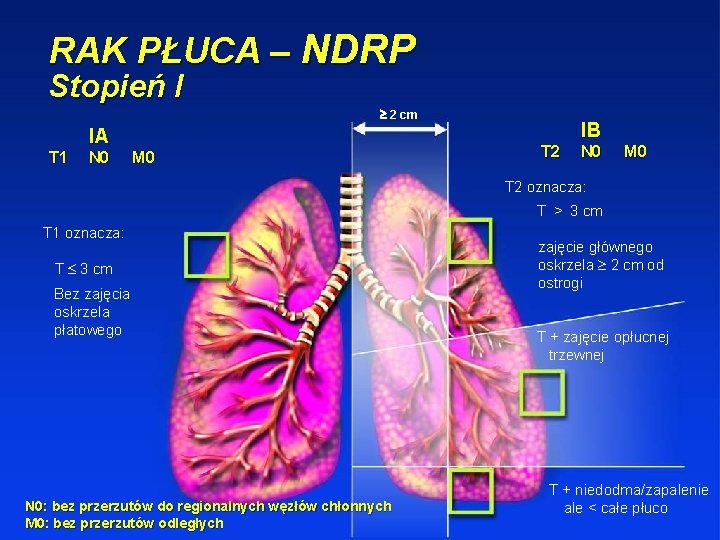 RAK PŁUCA – NDRP Stopień I 2 cm IA T 1 N 0 M