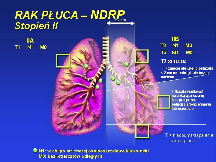 RAK PŁUCA – NDRP Stopień II 2 cm IIB IIA T 1 N 1