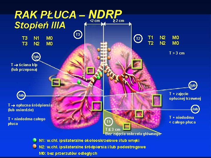 RAK PŁUCA – NDRP Stopień IIIA T 3 N 1 N 2 M 0