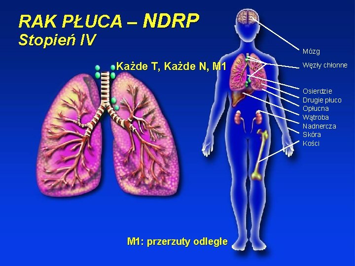 RAK PŁUCA – NDRP Stopień IV Mózg Każde T, Każde N, M 1 Węzły