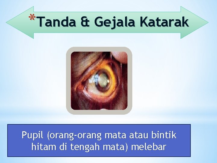 *Tanda & Gejala Katarak Pupil (orang-orang mata atau bintik hitam di tengah mata) melebar