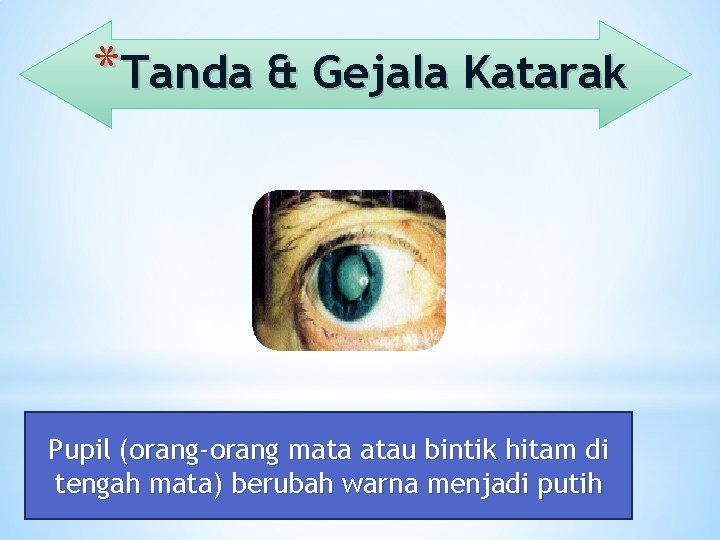 *Tanda & Gejala Katarak Pupil (orang-orang mata atau bintik hitam di tengah mata) berubah