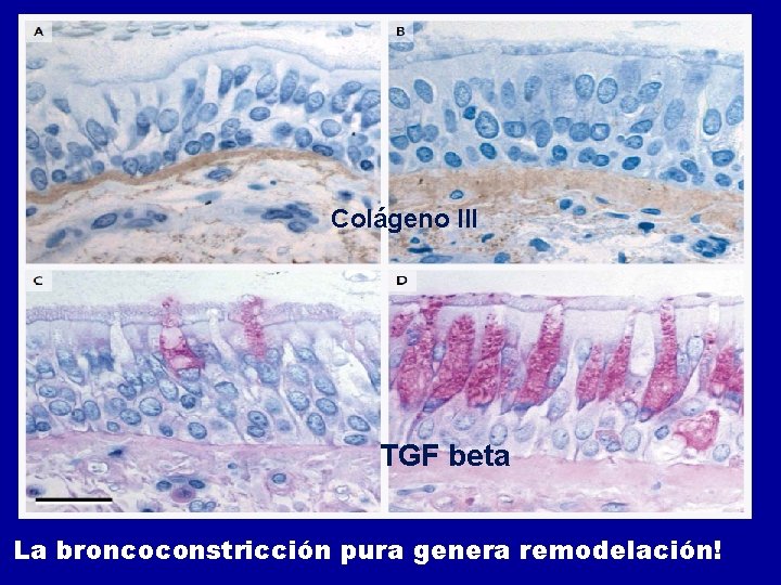 Colágeno III TGF beta La broncoconstricción pura genera remodelación! Colágeno III TGF beta La broncoconstricción pura genera remodelación!