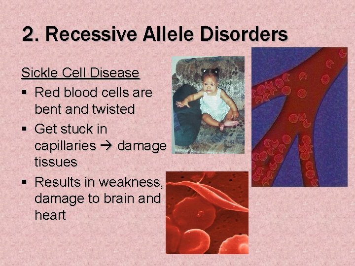 2. Recessive Allele Disorders Sickle Cell Disease § Red blood cells are bent and