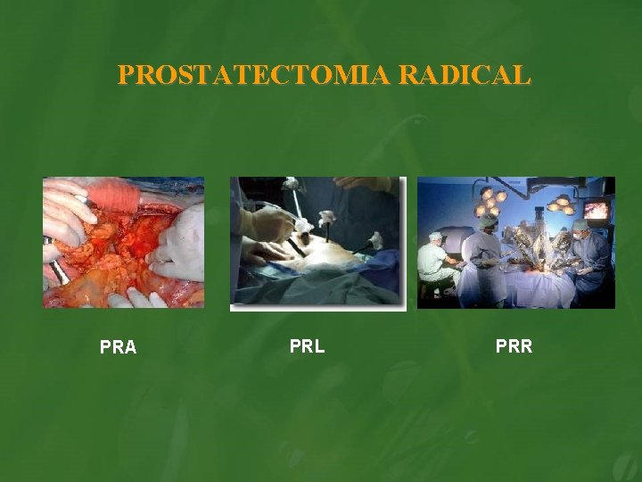 PROSTATECTOMIA RADICAL PRA PRL PRR 