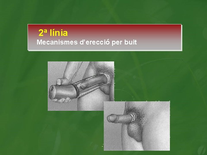 2ª línia Mecanismes d’erecció per buit 