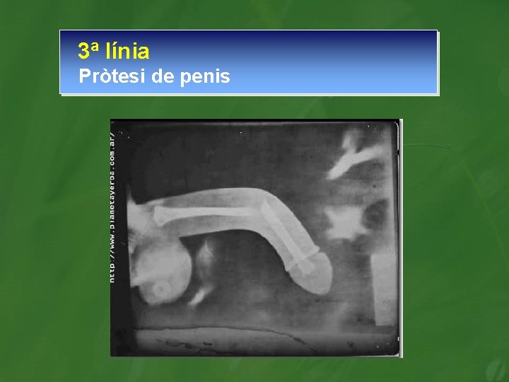 3ª línia Pròtesi de penis 