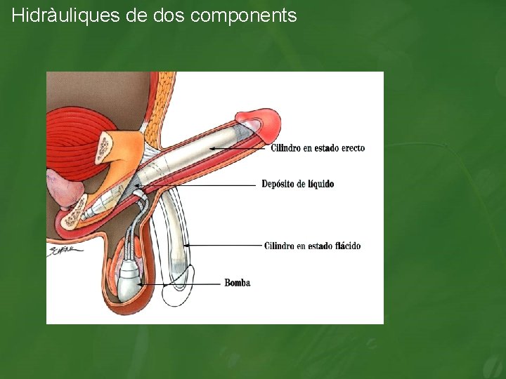 Hidràuliques de dos components 