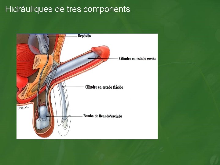 Hidràuliques de tres components 