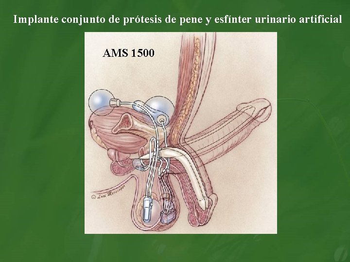 Implante conjunto de prótesis de pene y esfínter urinario artificial AMS 1500 