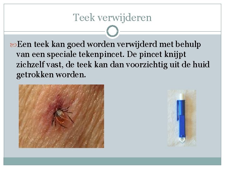 Teek verwijderen Een teek kan goed worden verwijderd met behulp van een speciale tekenpincet. Teek verwijderen Een teek kan goed worden verwijderd met behulp van een speciale tekenpincet.