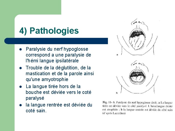 4) Pathologies l l Paralysie du nerf hypoglosse correspond a une paralysie de l'hémi